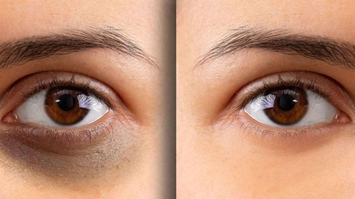 Under Eye Treatment