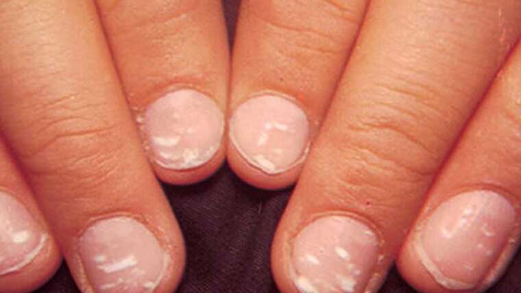 Nail Diseases Treatment