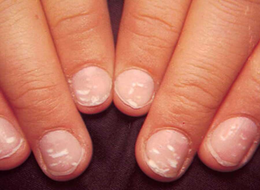 Nail Diseases Treatment