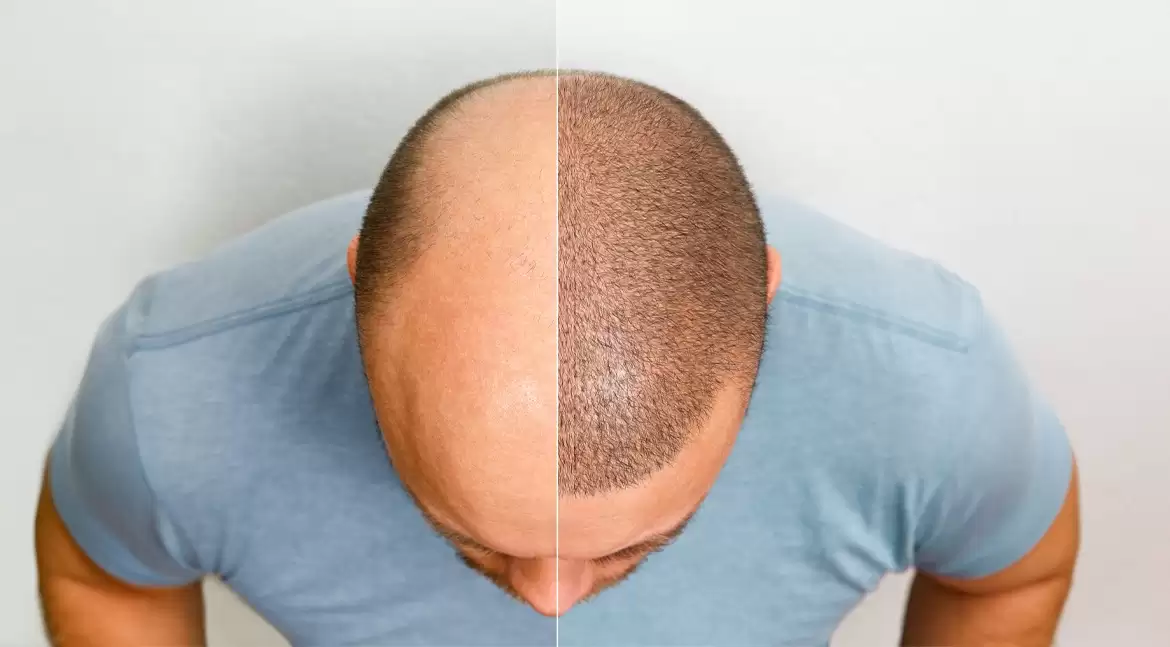 Hair Transplant in Pune: A Complete Guide to What Happens Before, During, and After