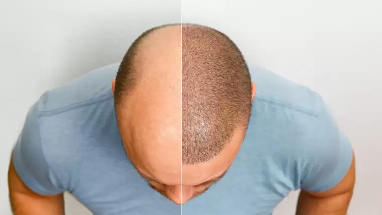 Hair Transplant in Pune: A Complete Guide to What Happens Before, During, and After